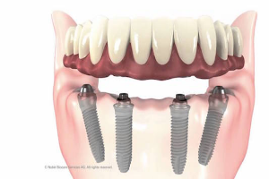 3) Implant Supported Dentures