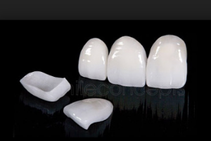 Teeth bleaching