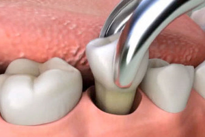 Dental extraction surgery