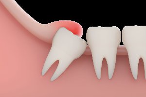 Dental impaction surgery