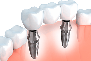 2) Implant Supported Bridges