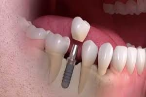 Single Tooth Implants