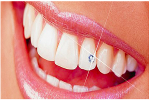 Tooth Jewellery implant