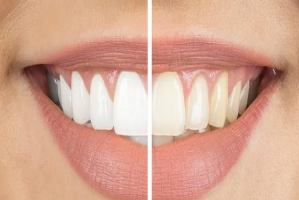 White and brown patches on teeth treatment using Microabrasion and resin infoltration