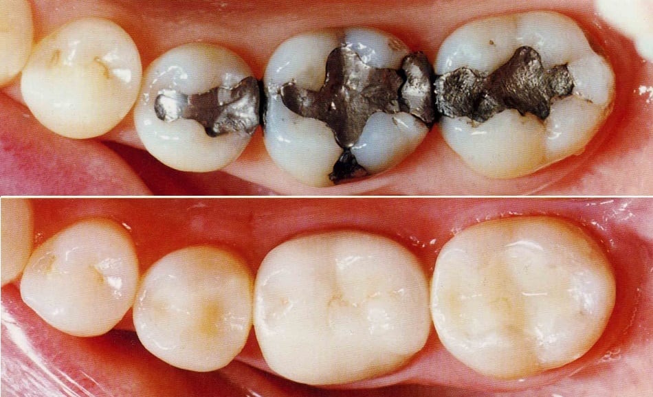 Tooth Coloured Fillings in Bangalore