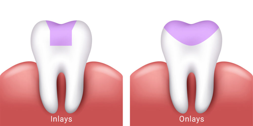 teeth inlay and onlay treatment