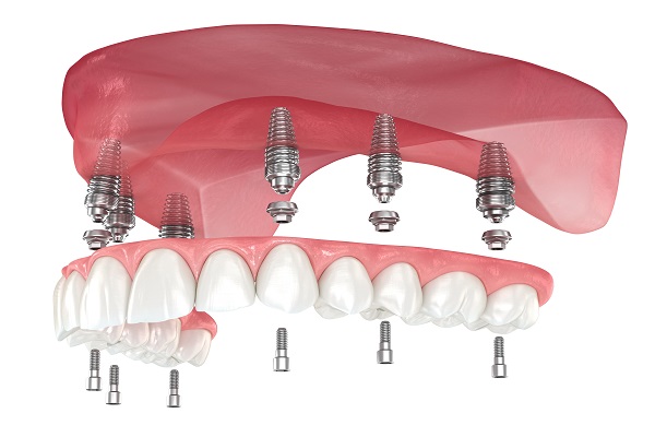 top side Implant supported denture