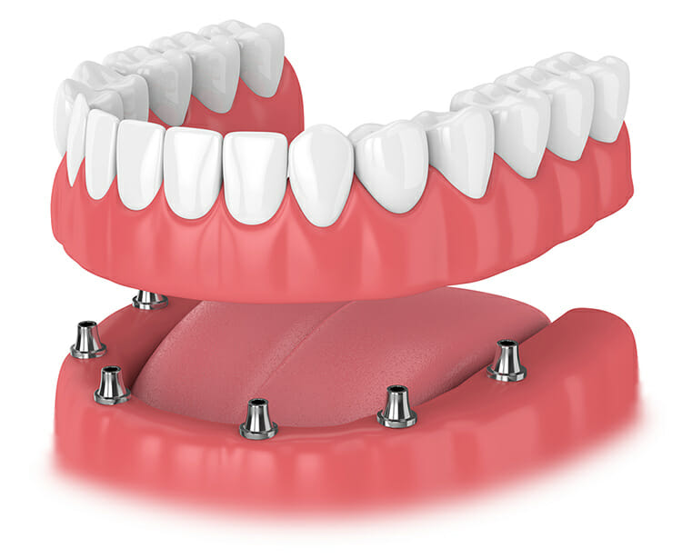 down side Implant supported denture
